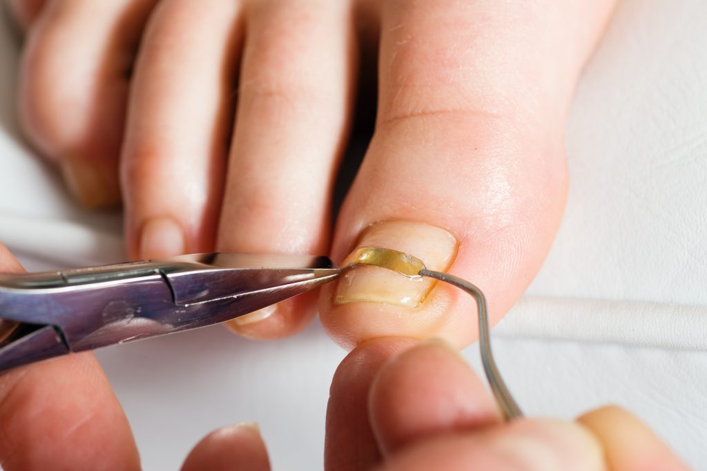 Tırnak batmaları ciddi rahatsızlık verebilir...