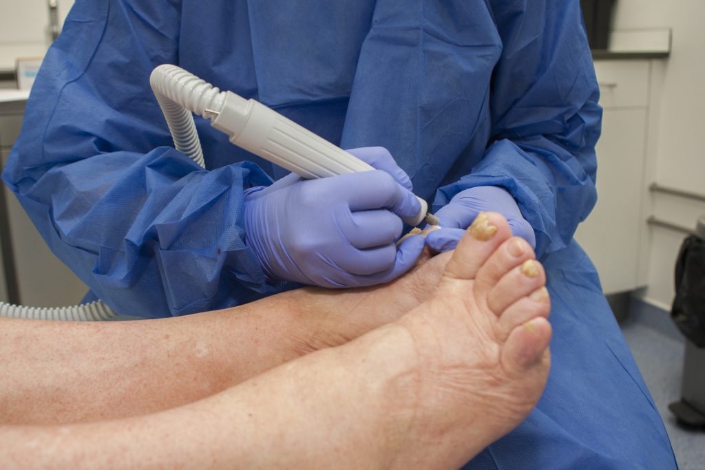 Tırnak mantarı ya da travmaya bağlı kalınlaşmış...